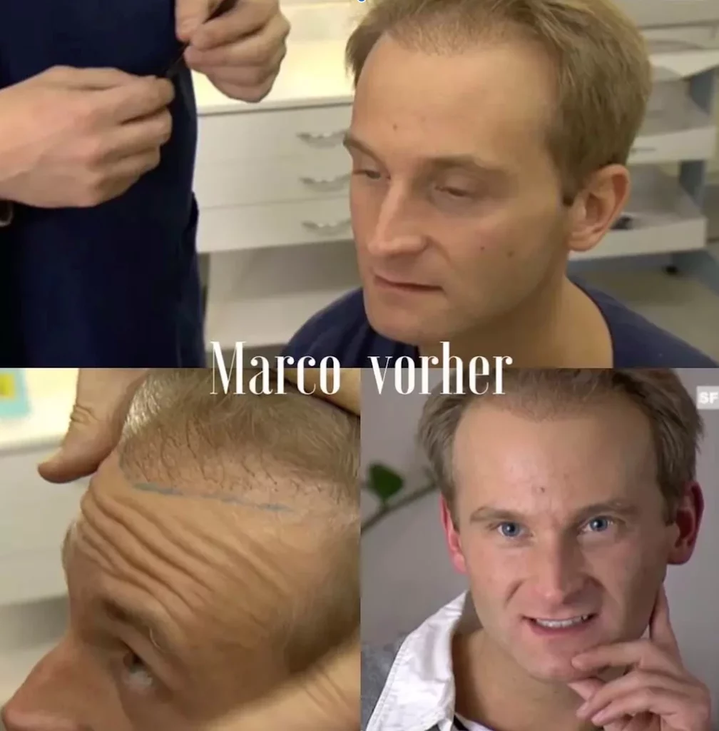 Vor der verpfuschten Haartransplantation und vor Reparatur Eingriff