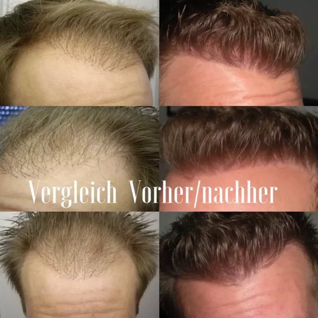 Misslungene verpfuschte Haartransplantation Resultat Vorher Nachher