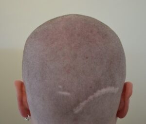 Misslungene Haartransplantation